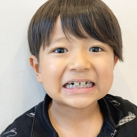 【小児歯科専門医が解説】わが子の「歯並び」が気になっている人必見！早めに進めたい治療のタイミングや矯正方法って？